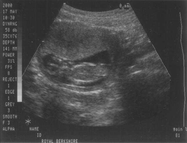 Scan 13 weeks