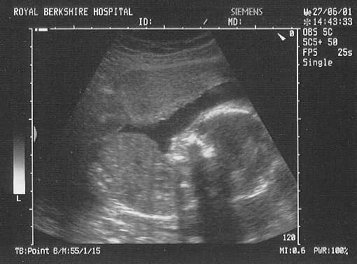 Scan 20 weeks